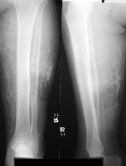 chronic venous insufficiency